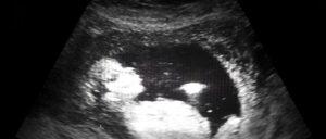sonogram - baby