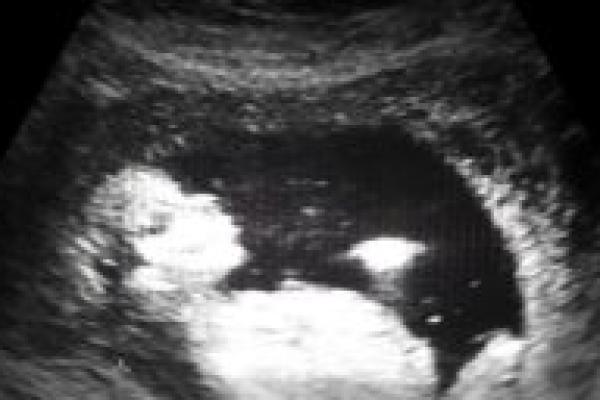 sonogram - baby