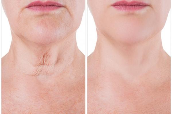 photo of two people's neck one showing aging