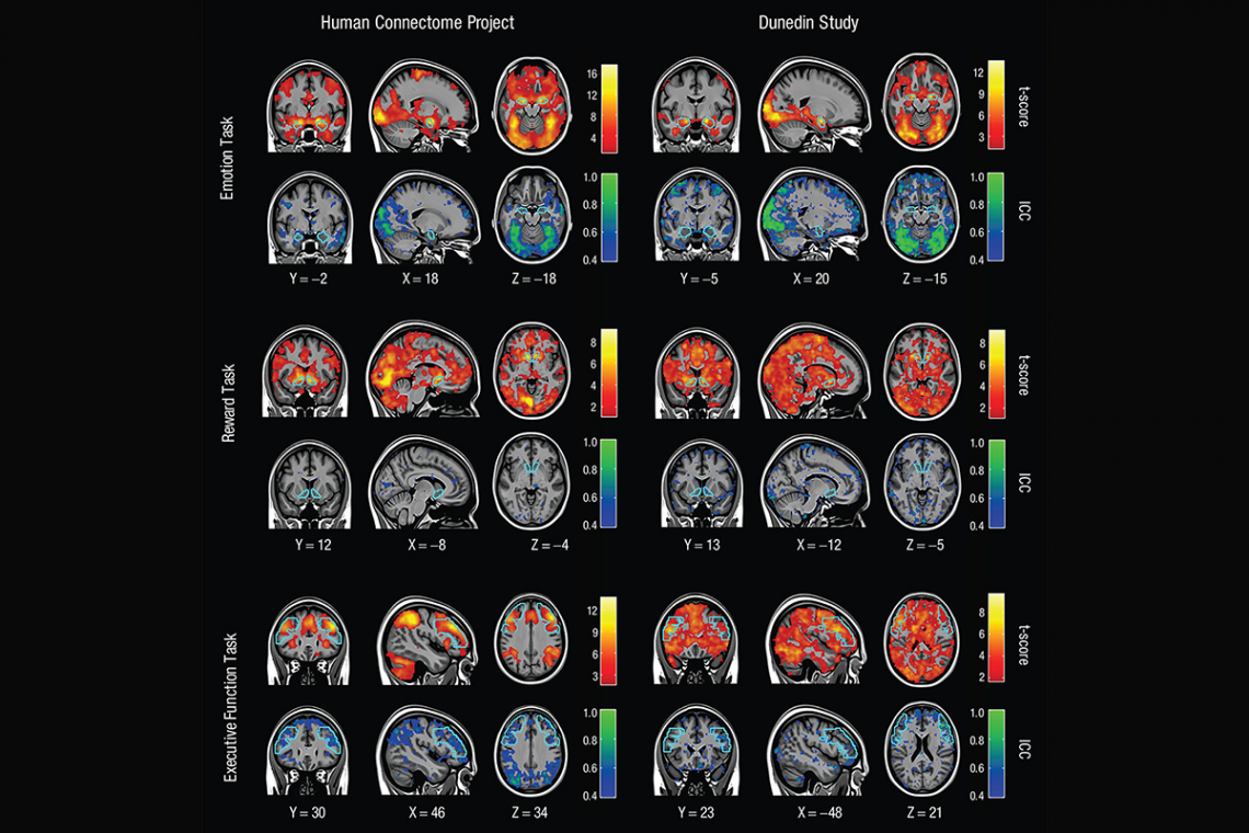 brain mri