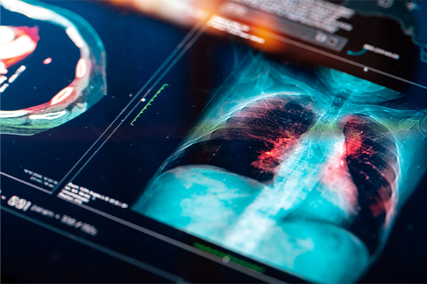 Medical scan of lungs