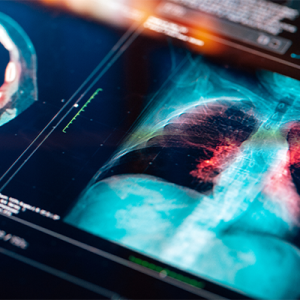 Medical scan of lungs